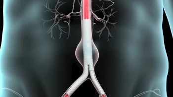 Abdominal Aortic Aneurysm Evaluation and Management