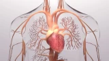 HHT/Pulmonary AVM Monitoring and Embolization
