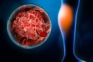 May-Thurner Syndrome Evaluation and Management