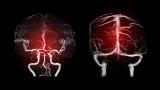 Carotid Cavernous Fistula (CCF) Embolization