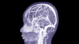 Dural Venous Sinus Thrombosis Thrombectomy