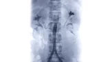 Spinal Vascular Malformation Embolization