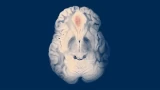 Chronic Subdural Hematoma Embolization