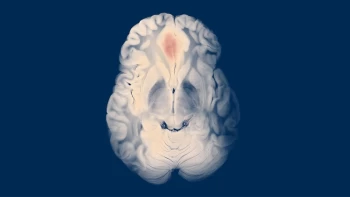Chronic Subdural Hematoma Embolization