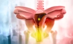 Non-Surgical Uterine Fibroid Treatment/Embolization