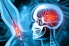 Venous Sinus Stenosis Stenting